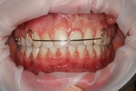 Ząb atypowy