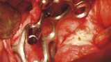 Ryc. 10. Prawa siatka tytanowa in situ przymocowana do tkanki kostnej szczęki za pomocą śruby do osteosyntezy.