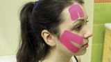 Ryc. 3. Aplikacja kinesiology taping® – technika powięziowo-korekcyjna w porażeniu nerwu twarzowego.
