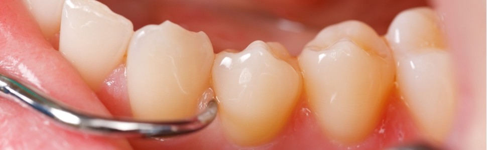 Sposób postępowania z głęboko zatrzymanym  zębem trzonowym trzecim żuchwy i rozległą torbielą zębopochodną,  mający na celu uniknięcie urazu nerwu zębodołowego oraz  poprawienie gojenia się tkanek przyzębia – opis przypadku