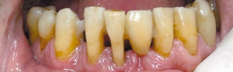 Szynowanie zębów rozchwianych z jednoczesnym odtworzeniem utraconego zęba