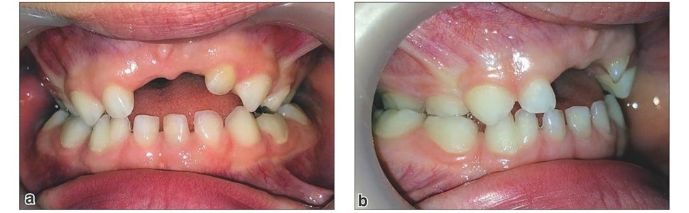 Zaburzenia zgryzu w uzębieniu mlecznym – kiedy rozpocząć leczenie ortodontyczne?