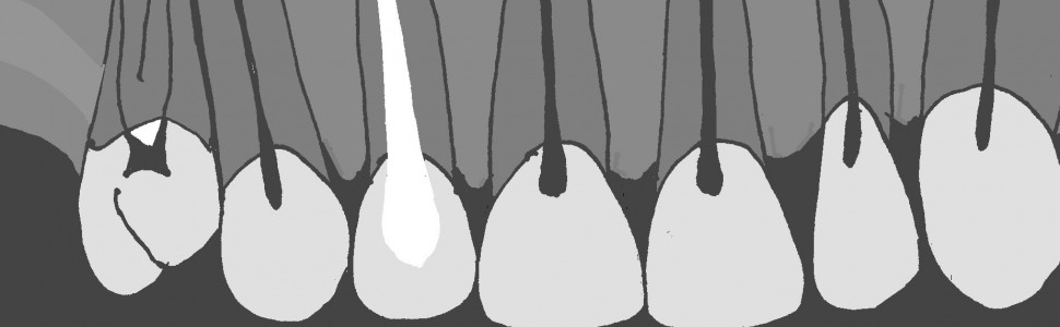 Zachowanie żywotności zębów sąsiadujących z dużą torbielą korzeniową