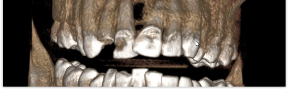 ARTYKUŁ Z FILMEM. Warunkowe leczenie endodontyczne zębów 12 i 11 – obserwacje 2-letnie