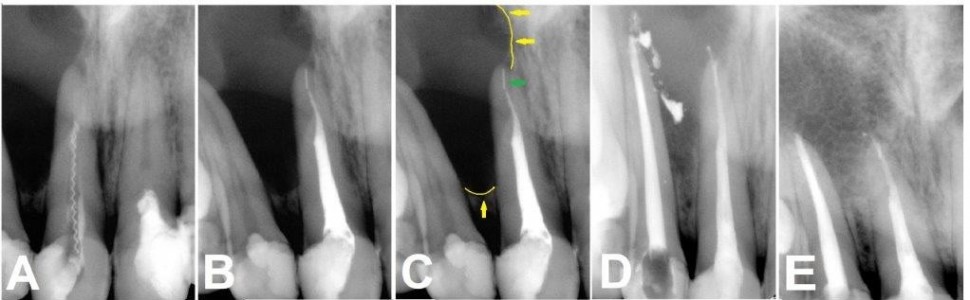 Leczenie endodontyczne zębów siecznych szczęki z rozległą zapalną zmianą okołokorzeniową
