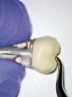 Powtórne leczenie endodontyczne zęba z szerokim otworem