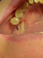 Czy ekstrakcje zębów u pacjentów w trakcie terapii bisfosfonianami są przeciwwskazane?