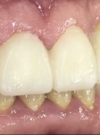 REPORTAŻ KLINICZNY: Wspomagana komputerowo odbudowa zębów w strefie estetycznej. Opis przypadku