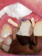 REPORTAŻ KLINICZNY: Estetyczna odbudowa bezpośrednia zębów odcinka przedniego. Opis przypadku