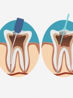 Mapa endodontyczna zębów trzonowych
