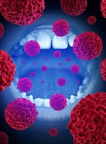 Profilaktyka onkologiczna w gabinecie stomatologicznym cz. 2