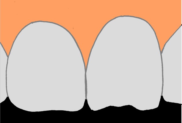 Specjalista radzi - licówki - ryc. 1