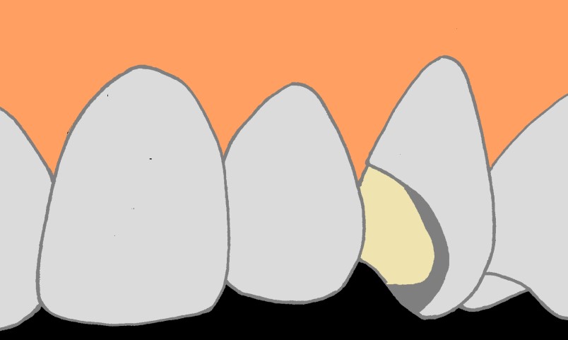 Specjalista radzi - licówki - ryc. 5