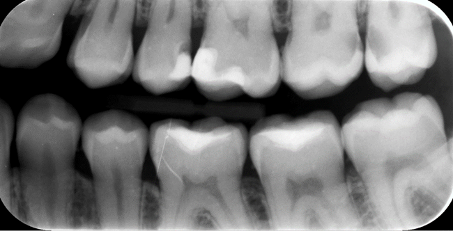 Diagnostyka próchnicy 1 Diagnostyka próchnicy 1