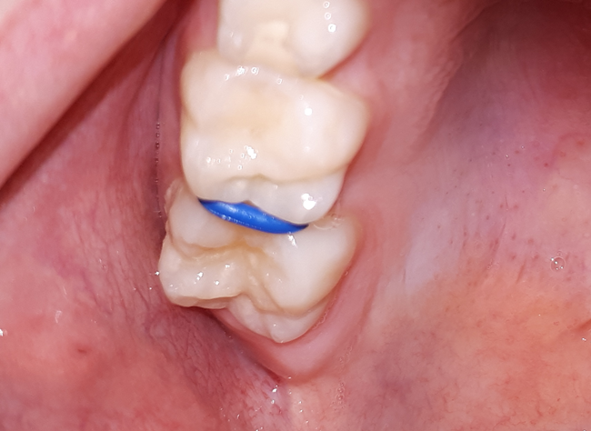 Diagnostyka próchnicy 2 Diagnostyka próchnicy 2