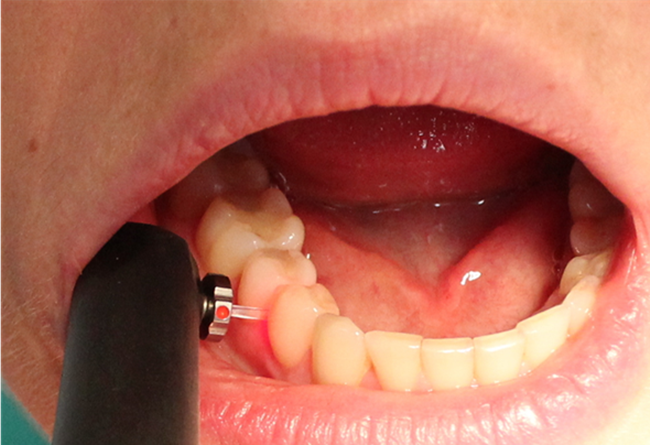 Diagnostyka próchnicy 3 Diagnostyka próchnicy 3