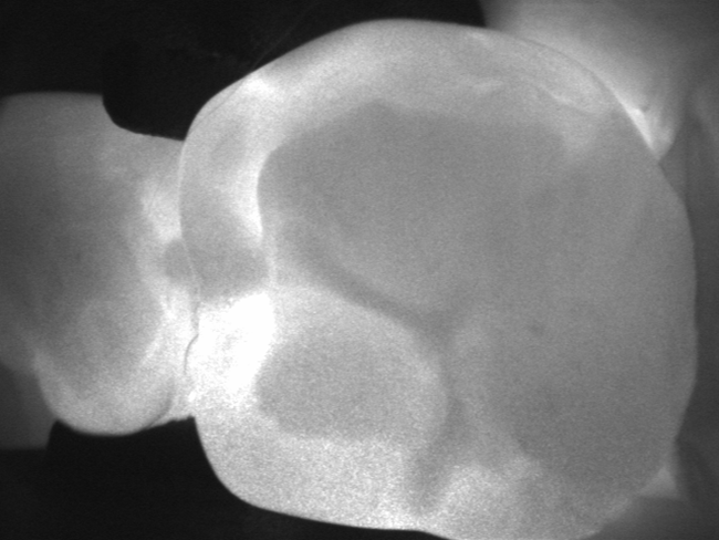 Diagnostyka próchnicy 4 Diagnostyka próchnicy 4