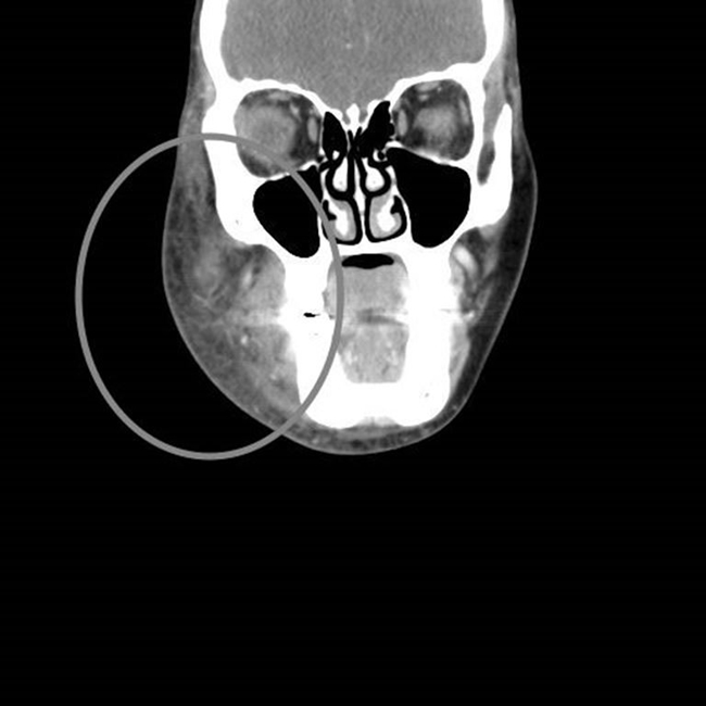 Podchloryn sodu ryc. 2b