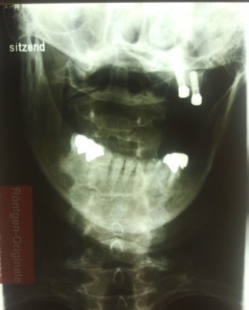 Ryc.5.Zmiany strukturalne stawu szczytowo-obrotowego lewego u kobiety 54-letniej widziane na zdjęciu rentgenowskim.