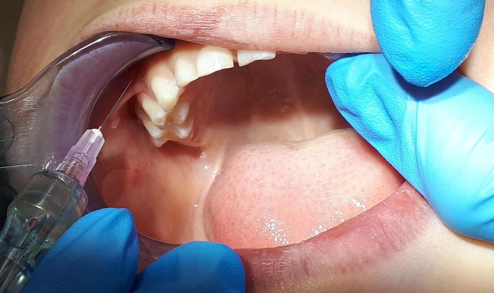 MS 1 Znieczulenie nasiękowe