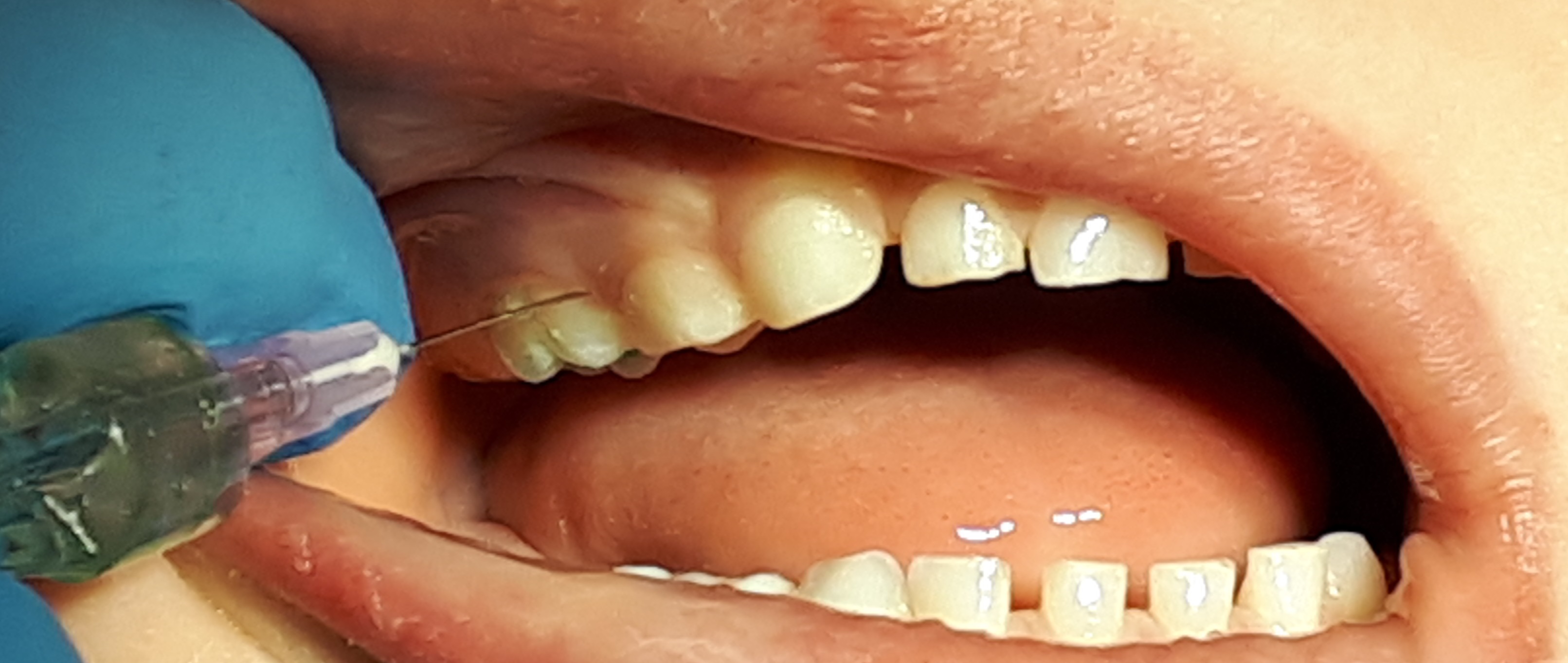 MS 1 Znieczulenie przezbrodawkowe. A.