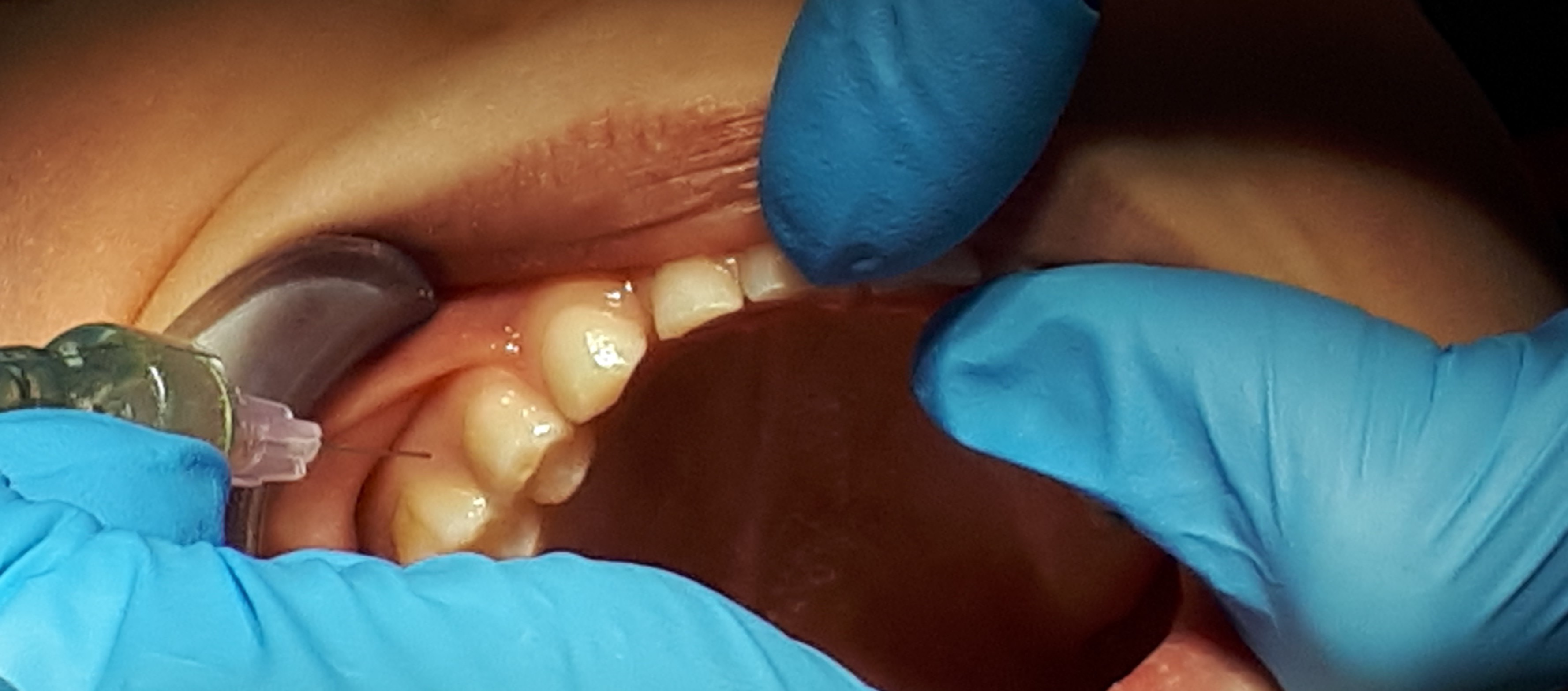 MS 1 Znieczulenie przezbrodawkowe. B.