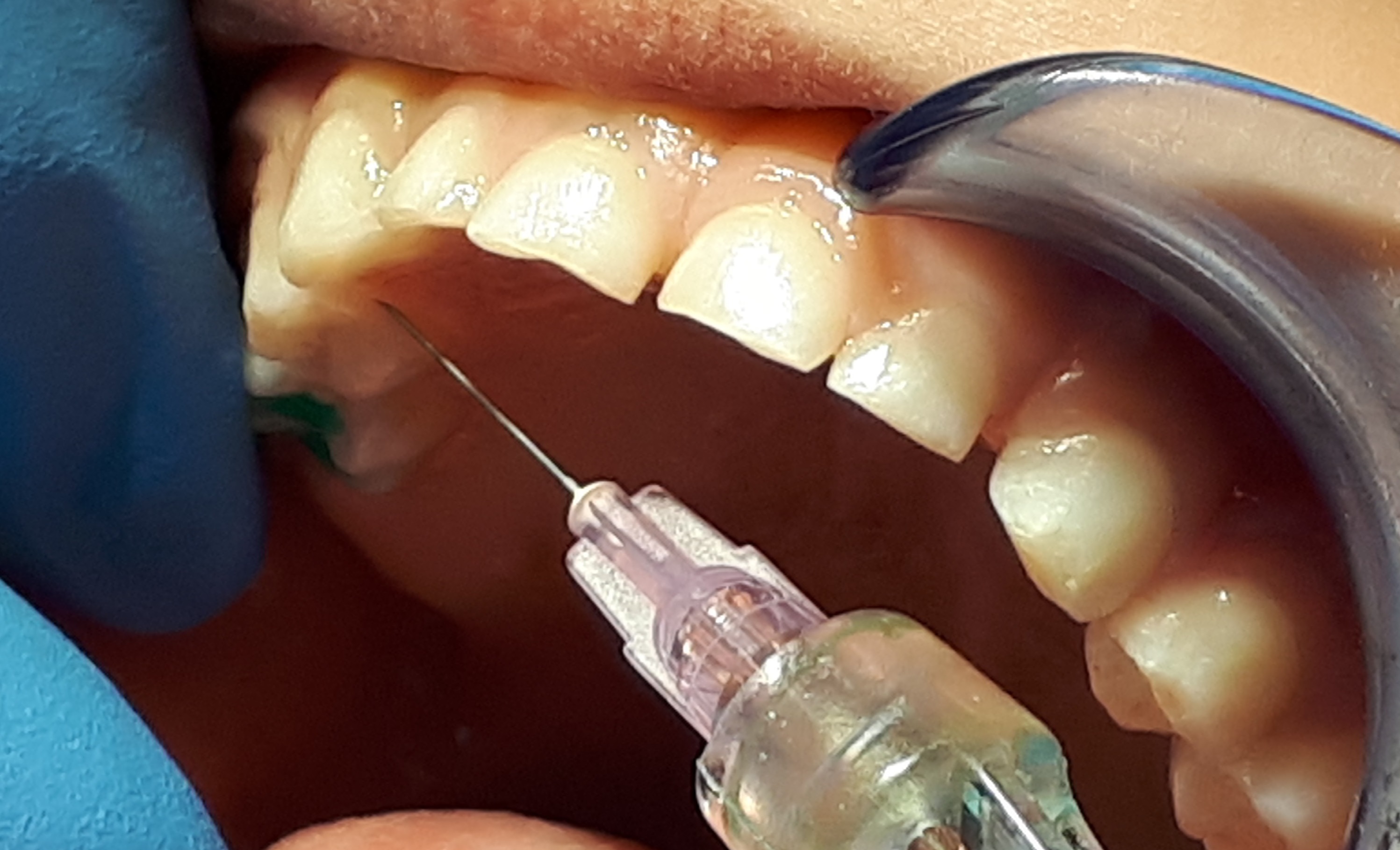 MS 1 Iniekcja środka znieczulającego