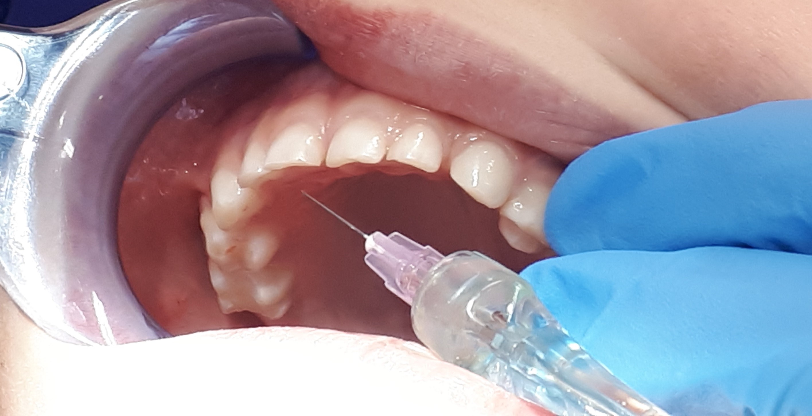 MS 1 Znieczulenie błony śluzowej podniebienia