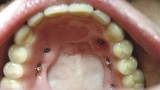 Ryc. 8a. Proteza docelowa z zamkniętymi ryglami. Pacjentka całkowicie odzyskała kontrolę nad funkcją jamy ustnej, znów może czerpać radość z życia.