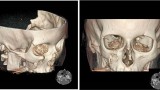Złamanie twarzoczaszki typu kompleksu jarzmowo‑szczękowego (ZMC) praktycznie z oderwaniem kości jarzmowej, szczelinami złamania obejmującymi ściany zatoki szczękowej prawej.