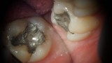 Ryc. 7. Przypadek 1. Ubytek próchnicowy w zębie 47.