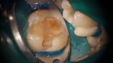 Ryc. 8. Przypadek 1. Oszczędzające miazgę opracowanie ubytku próchnicowego w zębie 47.