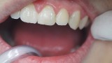 Ryc. 16. Przypadek 2. Ubytek w zębie 23 przed preparacją.