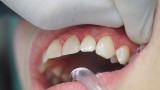 Ryc. 26. Przypadek 2. Wypełnienie ostateczne w zębie 23.