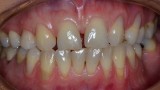 RYC. 1. Recesje w okolicy zebów 23 i 24 z ubytkami niepróchnicowego pochodzenia pokryte materiałem kompozycyjnym. Pacjentka przed leczeniem ortodontyczym.