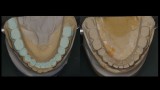 Ryc. 20. Na model istniejącej sytuacji nałożono kontury zębów po planowanym leczeniu ortodontycznym (lewa strona) z modelu studyjnego (prawa strona). 