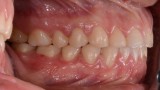 Ryc. 23. Zdjęcie wewnątrzustne po leczeniu ortodontycznym. 