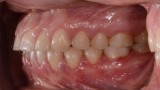 Ryc. 24. Zdjęcie wewnątrzustne po leczeniu ortodontycznym. 