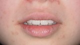 Ryc. 26. Mock-up weryfikujący planowane zmiany pozycji brzegów siecznych i zenitów dziąsłowych przednich zębów. 