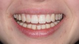 Ryc. 27. Mock-up weryfikujący planowane zmiany pozycji brzegów siecznych i zenitów dziąsłowych przednich zębów. 