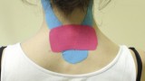 Ryc. 5. Aplikacja kinesiology taping® w obrębie kręgosłupa szyjnego; technika w kształcie „V” – mięśniowa oraz technika „I” – więzadłowa.