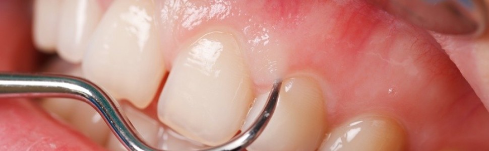 Choroby błony śluzowej jamy ustnej