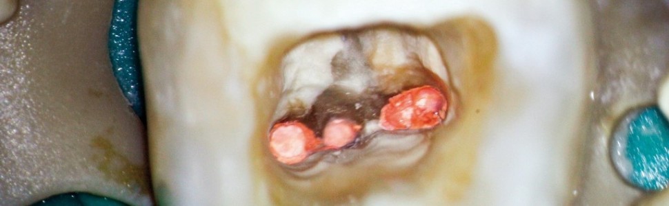 Powtórne leczenie endodontyczne pierwszego zęba trzonowego żuchwy z pięcioma kanałami