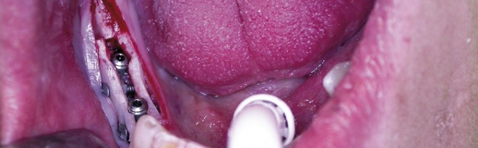 Leczenie implantologiczne w przypadku zaniku części zębodołowej żuchwy w odcinkach bocznych