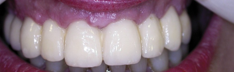 Koncepcje leczenia protetycznego opartego na wszczepach  śródkostnych