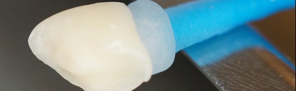 Rekonstrukcja korony leczonego endodontycznie zęba złamanego 