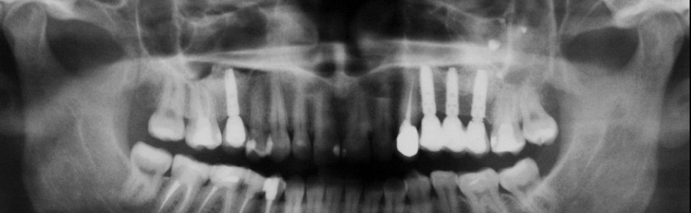 Leczenie implantologiczne w odcinkach bocznych szczęki