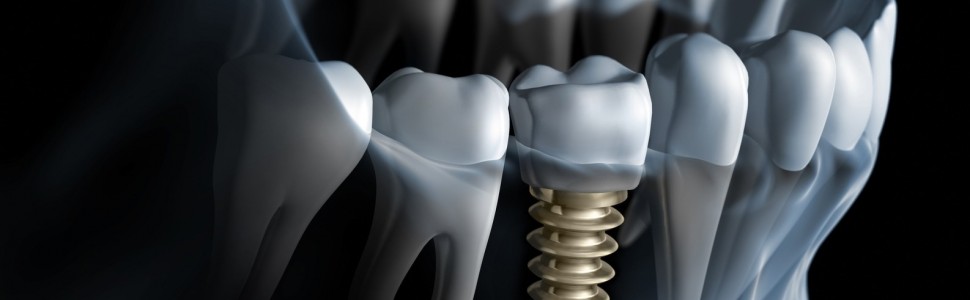 Obciążenie natychmiastowe wszczepów zębowych 