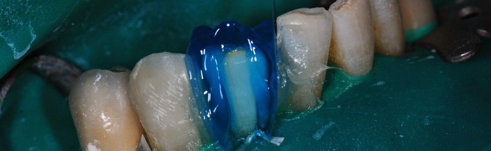 Odbudowy kompozytowe jako alternatywa leczenia ortodontycznego – fotoreportaż kliniczny