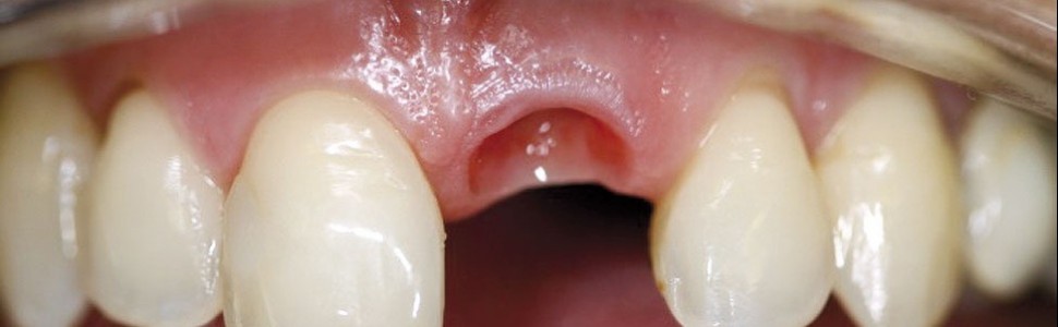 Strefa biologiczna wokół wszczepów zębowych